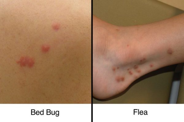 bedbug and Flea bites