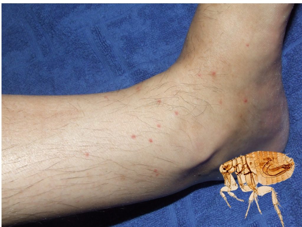 flea bites